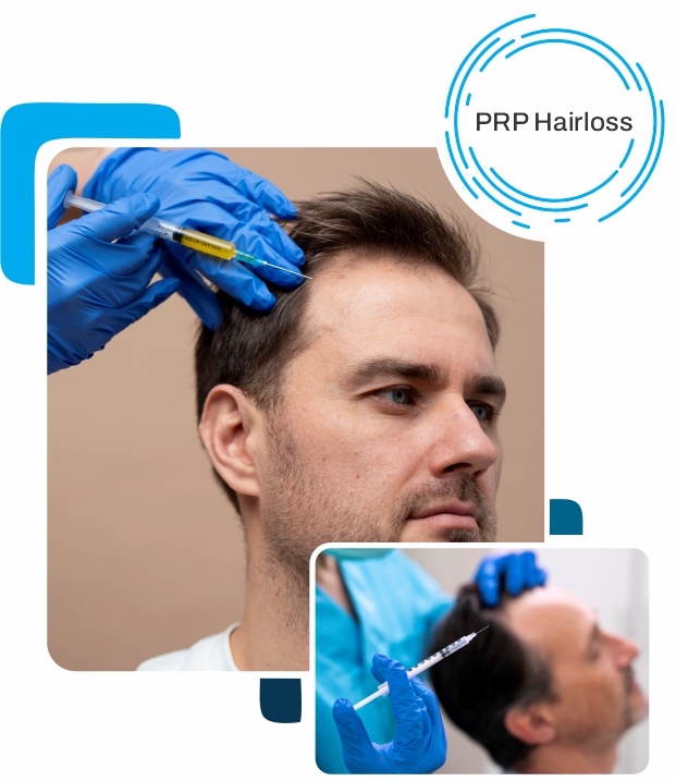 prp hairloss services north vancouver